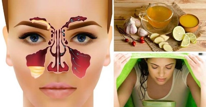 Remedios caseros para la sinusitis